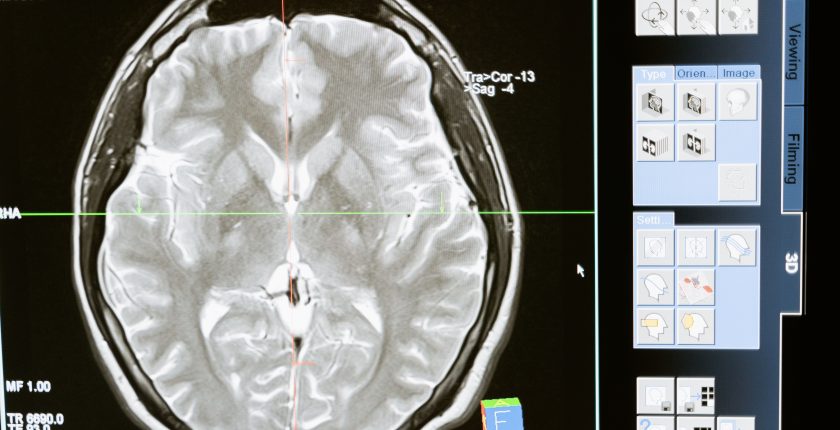 AI MedTech Brain Scan